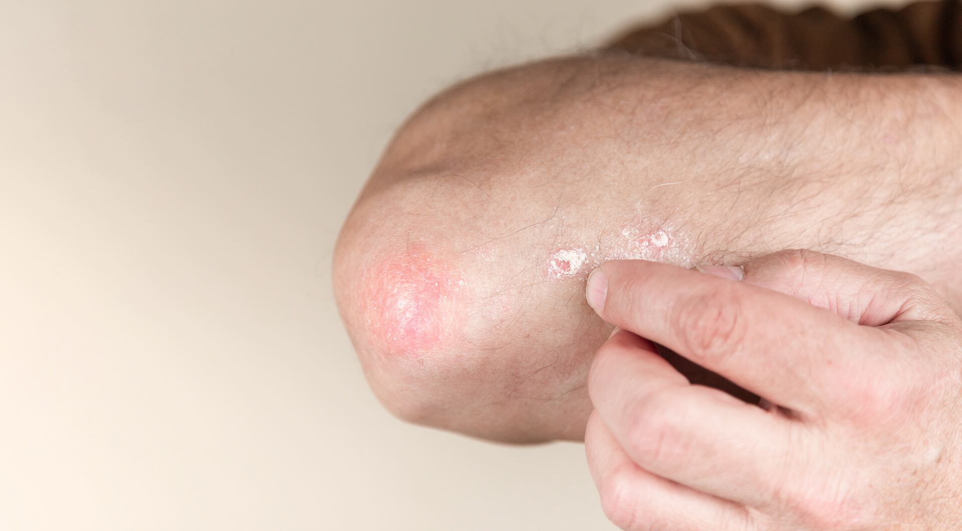 Factores ambientales como el calor y la sudoración empeoraron las manifestaciones de la dermatitis atópica Crédito: Freepik