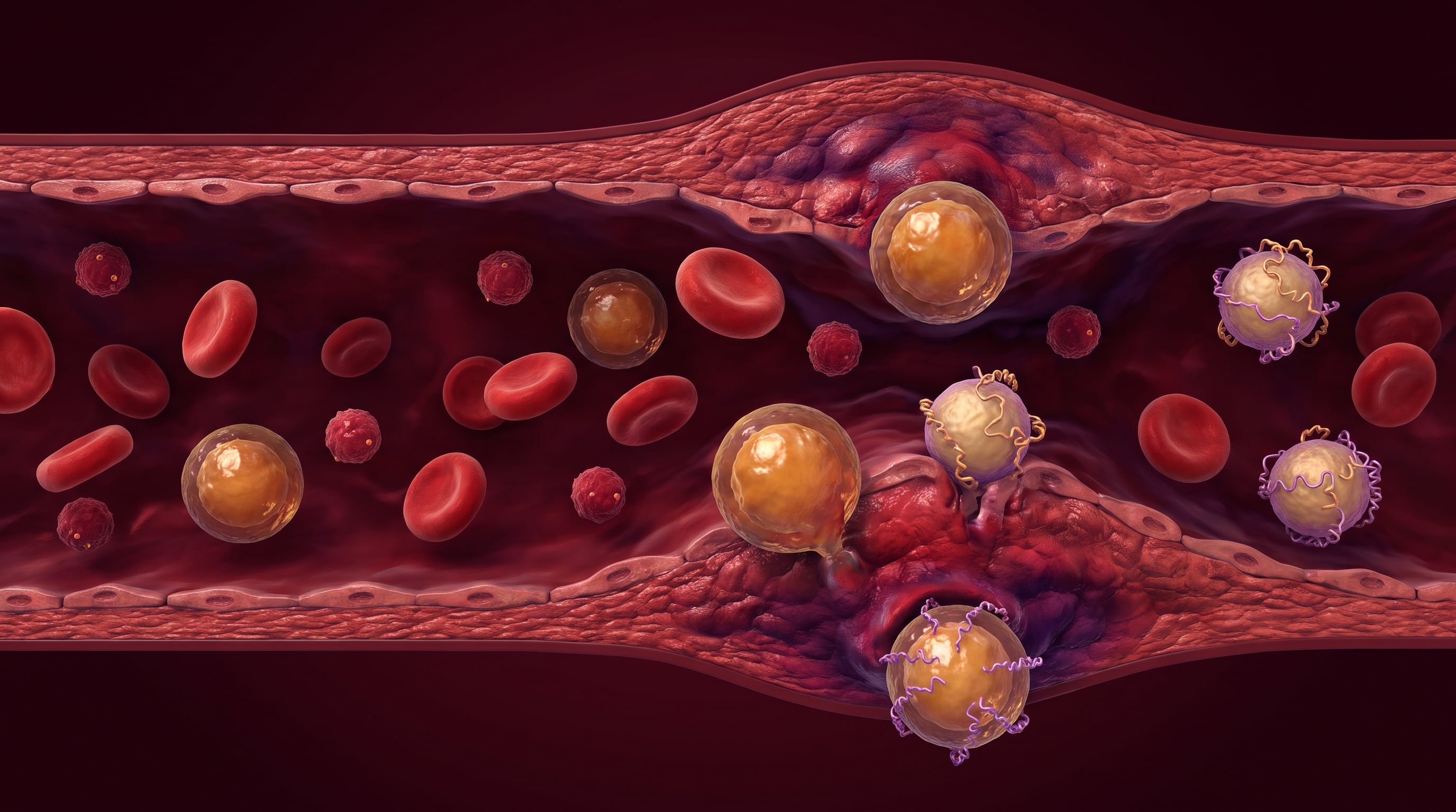 La lipoproteína(a) presenta una vinculación con la enfermedad coronaria de cuatro a cinco veces superior a la del colesterol LDL por partícula. (Imagen Ilustrativa Infobae)