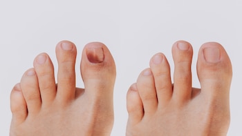 Una uña con mancha negra.