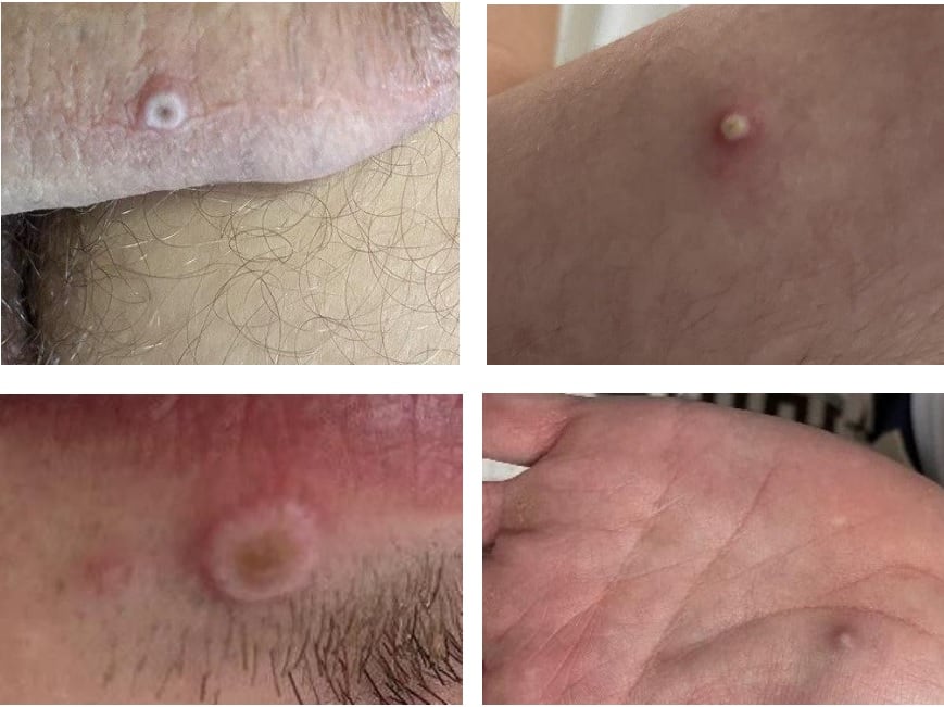 El contacto directo con lesiones, mucosas o superficies contaminadas es la principal vía de transmisión entre personas.
(iSanidad)