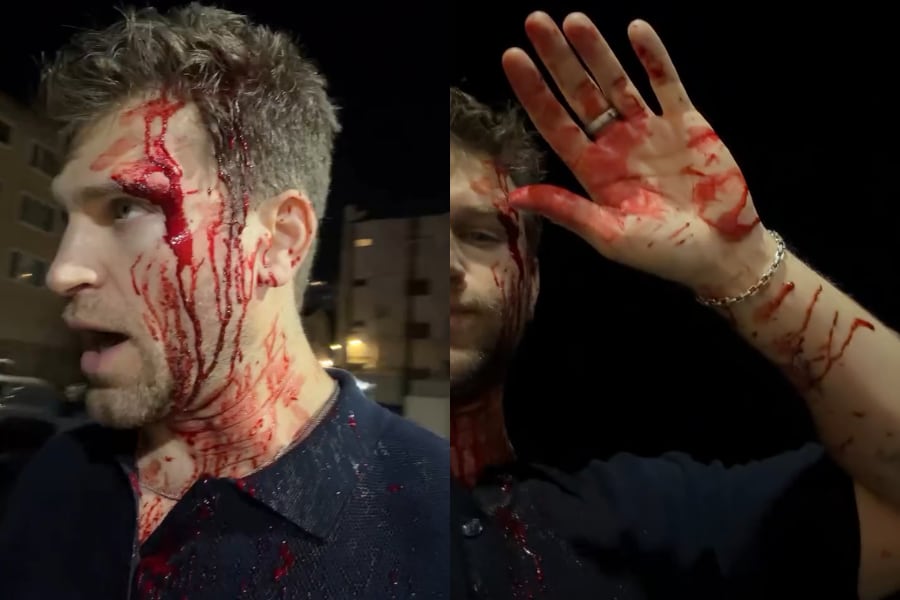 Keegan Allen sufrió un robo armado en California y mostró sus heridas