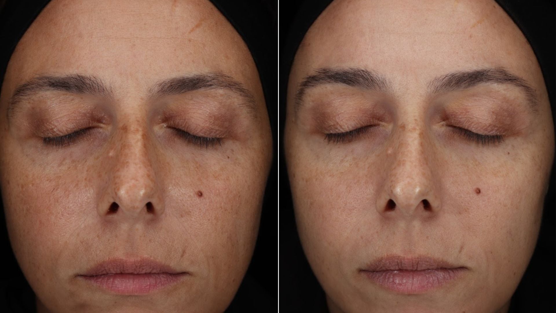 Dos fotografías en primer plano permiten comparar las manchas y la textura de la piel en el rostro de una persona.