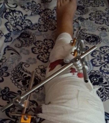 Primer plano de una pierna humana con un fijador externo y vendajes blancos manchados de sangre, apoyada sobre una sábana estampada