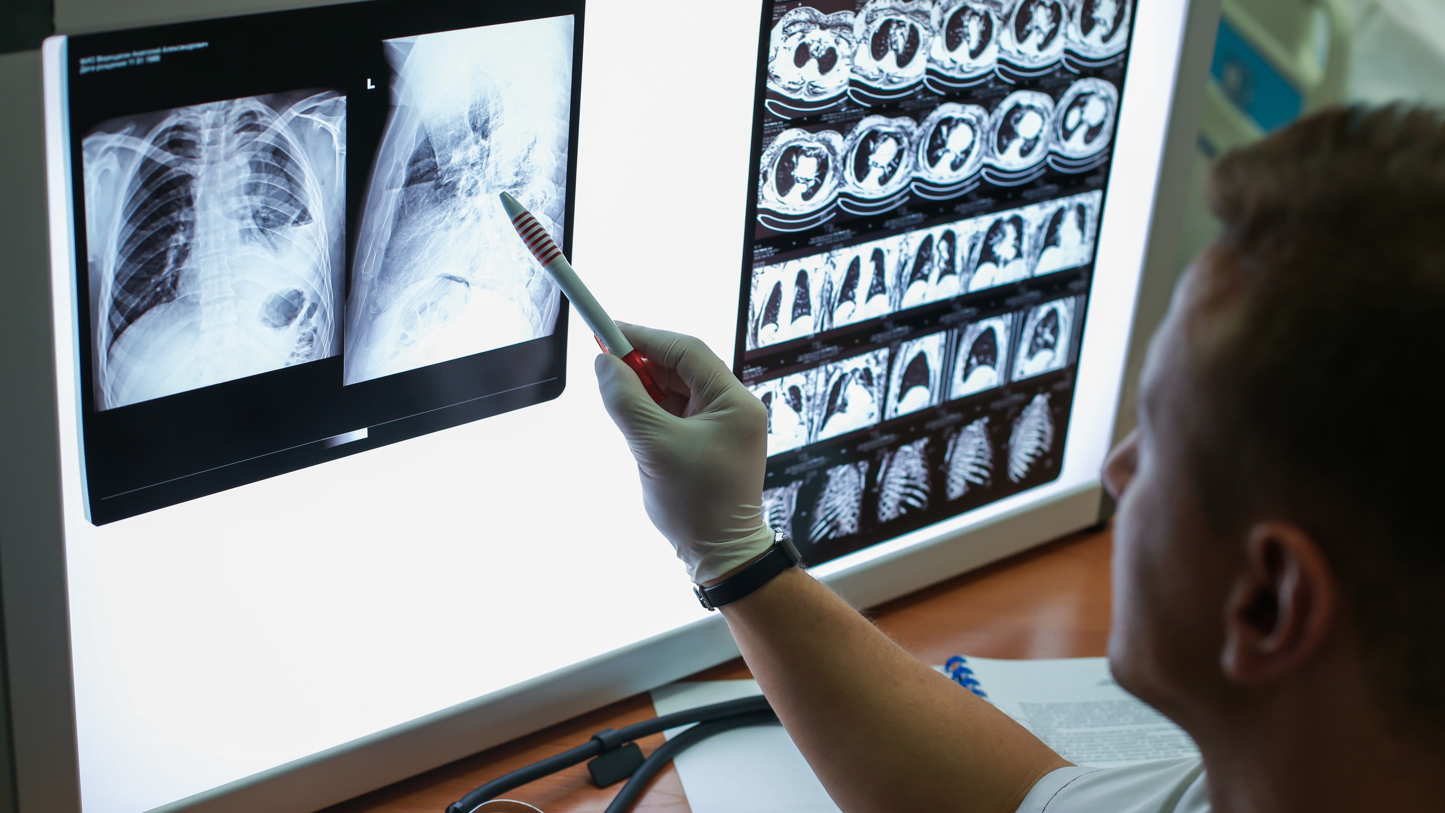 Un doctor observa una radiografía de pulmón (Shutterstock España)
