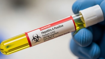Costa Rica investiga brotes activos de Hepatitis A en varias comunidades capitalinas y pide extremar medidas de higiene