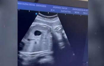Madre que esperaba gemelas acude al hospital Carrión, pero solo le entregaron a una y el médico se va de viaje
