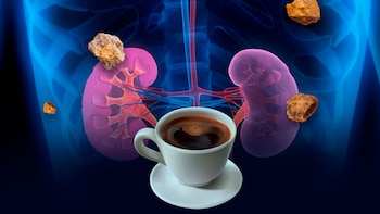 Cálculos renales: cuántas tazas de café al día pueden aumentar la eliminación de calcio a través de la orina