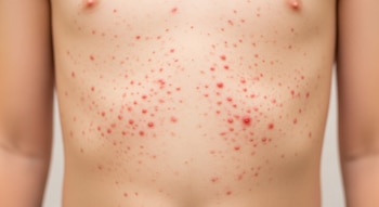 Imagen cercana del torso de un niño o joven, con la piel cubierta de numerosas erupciones cutáneas rojas, redondas y elevadas.