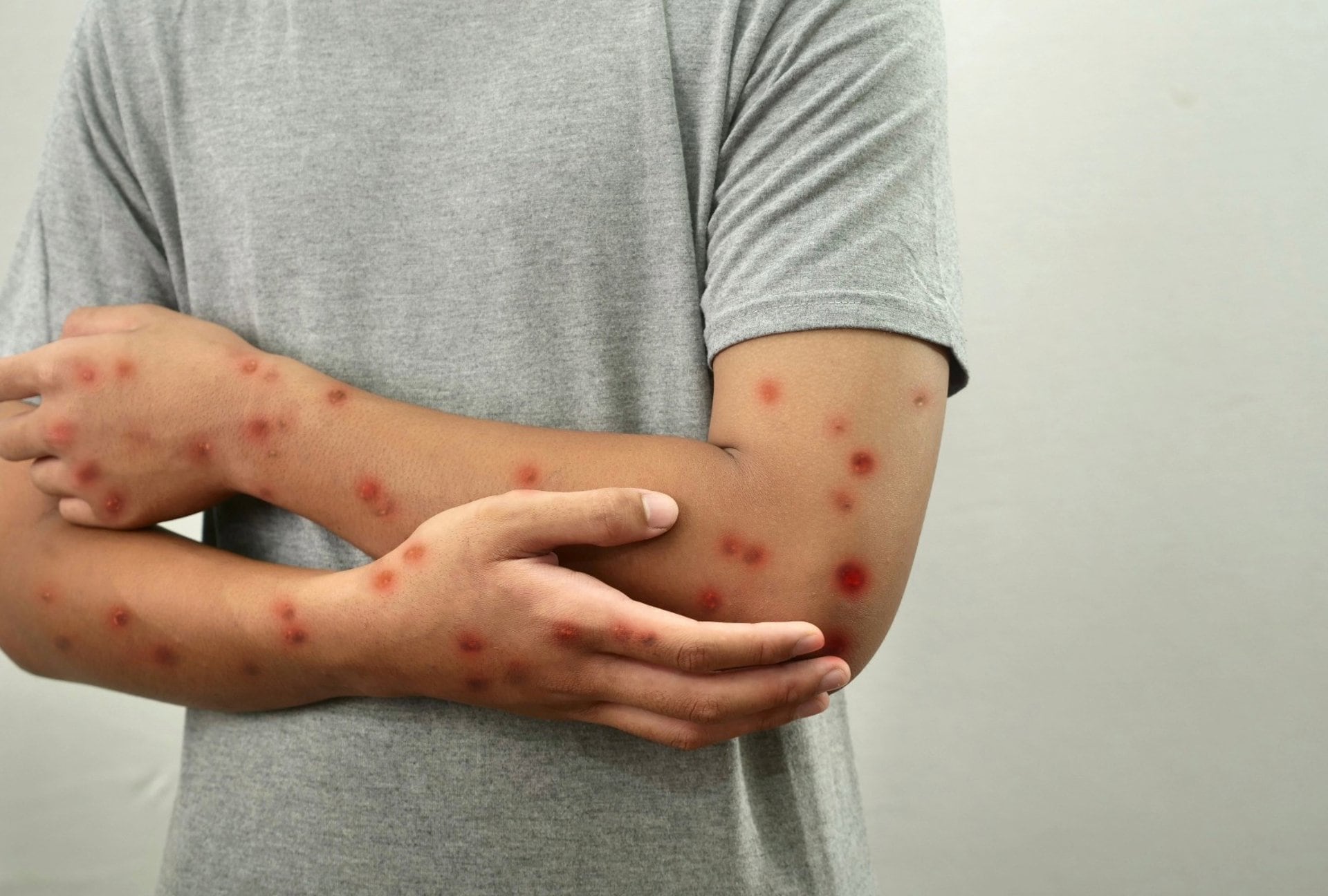 Prevén reforzar vacunación contra el sarampión con módulos del Metro y terminales de autobuses en CDMX