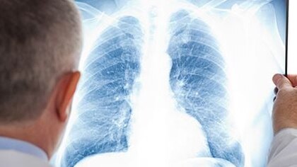 Cáncer de pulmón: la inmunoterapia aumenta la supervivencia antes y después de la cirugía 