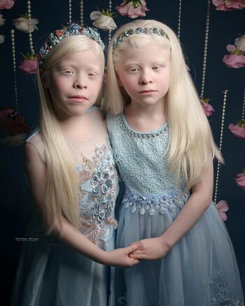 Fotos de las mellizas albinas