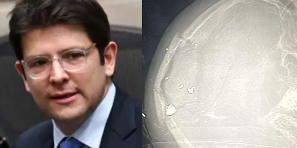 Filtran radiografía de Miguel Uribe Turbay: así quedó su cráneo tras el atentado - Infobae