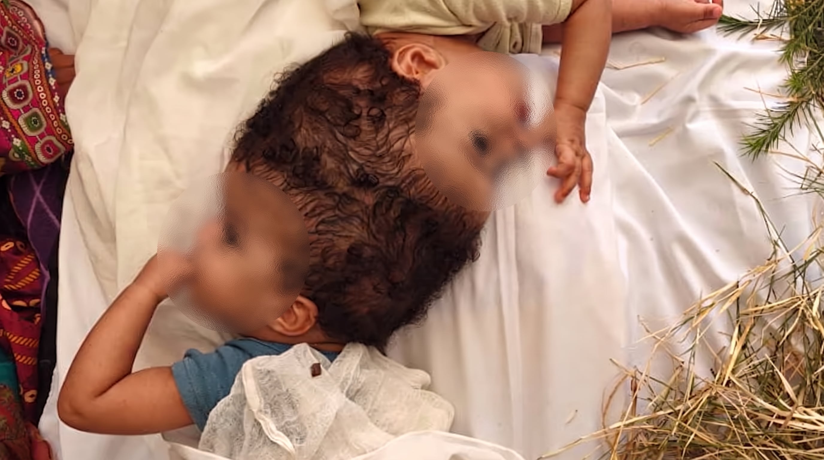 Las gemelas etíopes Hiyab y Wuhbto viven separadas seis meses después de una cirugía en San Luis, Misuri, que les permitió iniciar tratamientos por separado (Captura SSM Health Cardinal Glennon Children