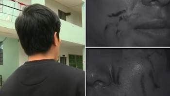 Un hombre de espaldas en una calle y dos recuadros con primeros planos de un rostro con arañazos en la boca, nariz y mejilla, en escala de grises