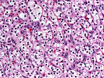 Las terapias dirigidas bloquean el