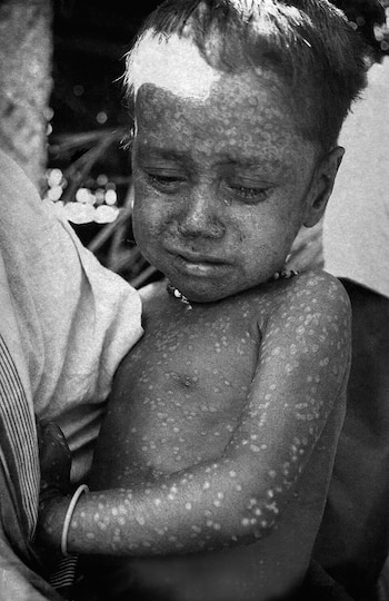 Imagen en blanco y negro de un niño pequeño con la piel del rostro, pecho y brazos cubierta de múltiples lesiones circulares típicas de la viruela