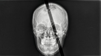 El accidente que sufrió en