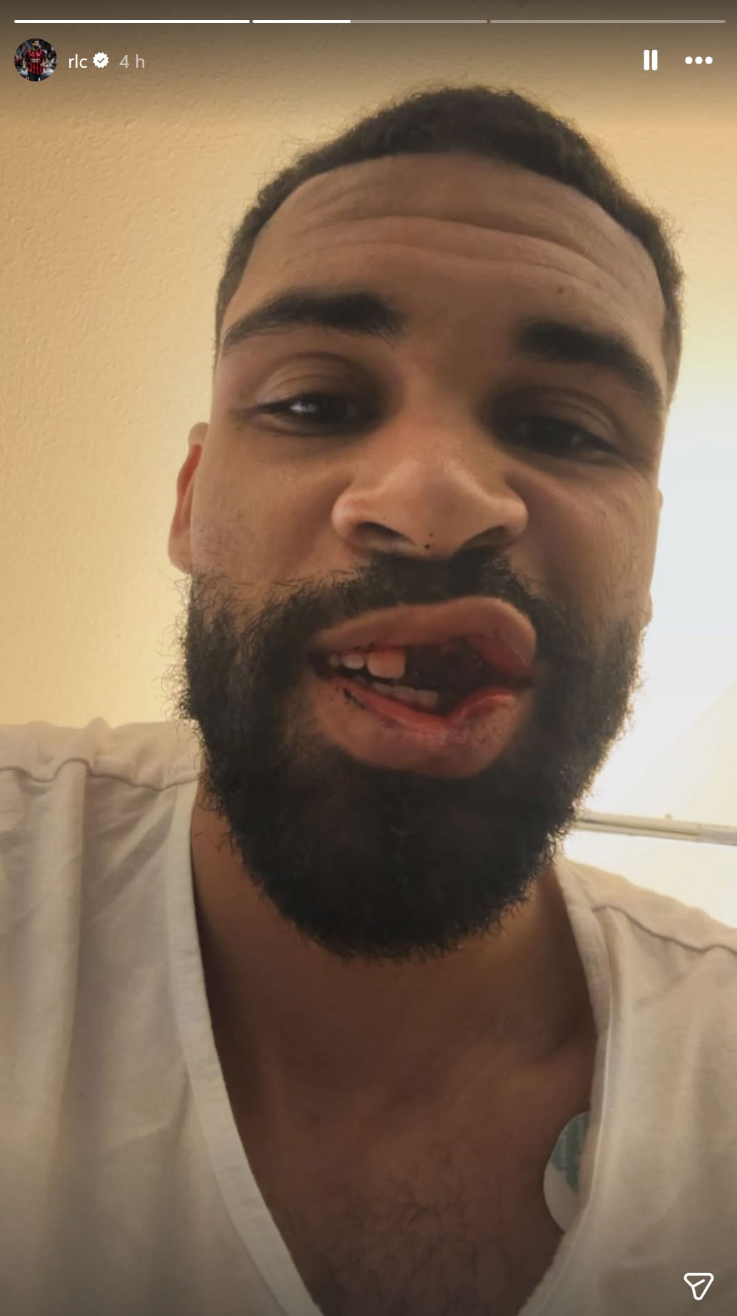 El estado del rostro de Loftus-Cheek después del golpe (@rlc)