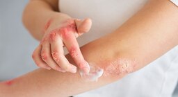 Lanzan una campaña gratuita para la detección de una enfermedad inflamatoria subdiagnosticada