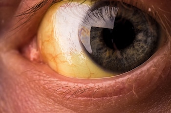 La coloración amarilla de la