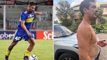 Herida por “mordedura humana” y