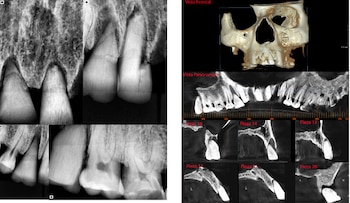 . Serie radiográfica periapical del maxilar superior, donde se observa la inserción de las réplicas óseas de camélido en los alvéolos maxilares, sin acople anatómico entre sus raíces y las paredes alveolares. La radiolucidez de los espacios circundantes no muestran signos de remodelado óseo, lo que es consistente con una intervención de carácter post-mortem y simbólico. (Radiografías digitales obtenidas por los autores; espécimen bajo autorización y custodia de la DDC Cusco).