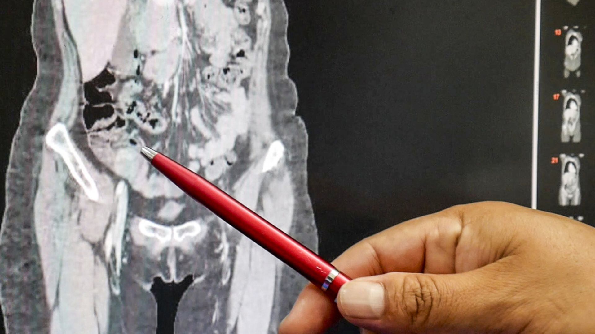 El procedimiento realizado fue una hemicolectomía derecha D3 por laparoscopía, una técnica de mínima invasión que permitió un proceso de recuperación más rápido y sencillo - Créditos: Essalud.