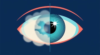 Ilustración de un ojo dividido verticalmente: la izquierda luce nublada y opaca, mientras la derecha muestra un iris turquesa claro y definido.