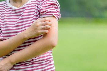 Las picaduras del mosquito suelen