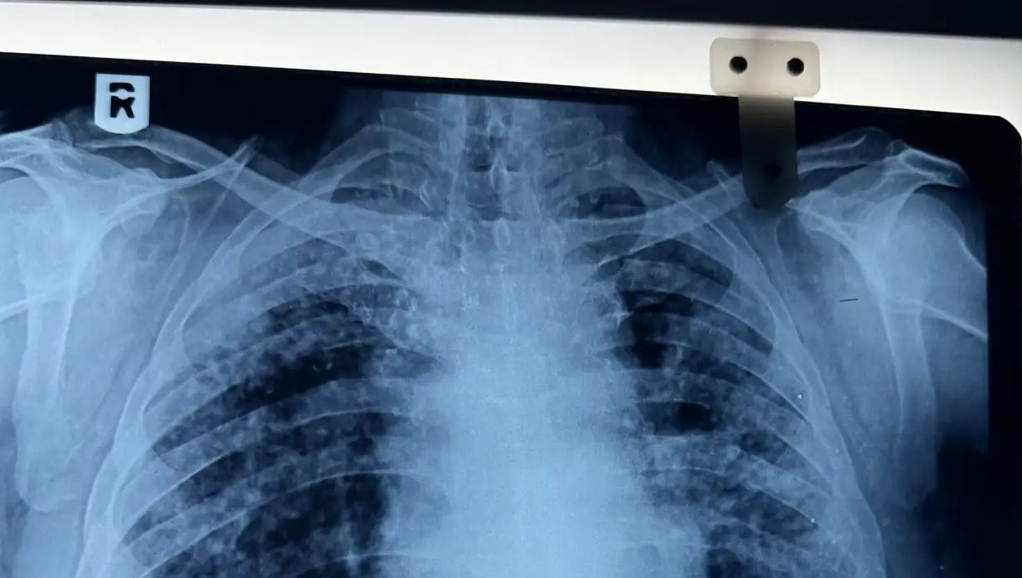 Alerta sanitaria: 6 de cada 10 empresas en estos sectores de Perú reportan altos niveles de silicosis entre sus trabajadores