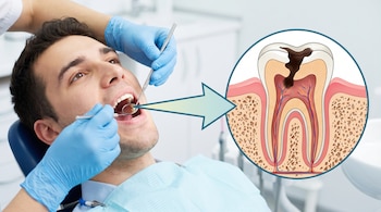Imagen de un hombre en silla dental con la boca abierta, examinado por un dentista con guantes azules. Una flecha apunta a una ilustración de un diente con caries.