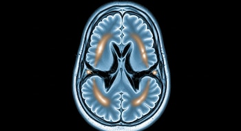 Resonancia magnética transversal del cerebro de un recién nacido. Se ven regiones de materia gris en azul y blanco, y degradados ámbar en la corteza sobre un fondo oscuro.