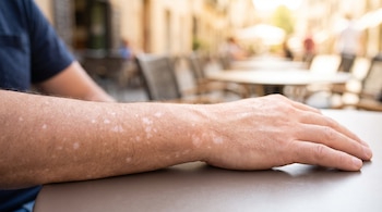 Un antebrazo con pequeñas manchas blancas sobre la piel permanece apoyado sobre una mesa en una terraza al aire libre.