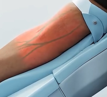 Antebrazo sobre un soporte médico azul con las venas resaltadas por una luz roja proyectada sobre la piel
