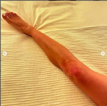 Anahí revela los moretones que