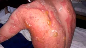 Las graves quemaduras sufridas en