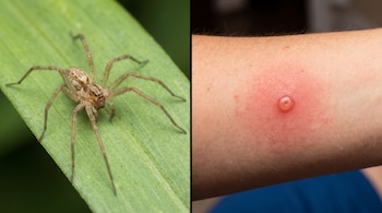 Imagen dividida con una araña marrón sobre una hoja verde a la izquierda y una ampolla con enrojecimiento en un brazo humano a la derecha.