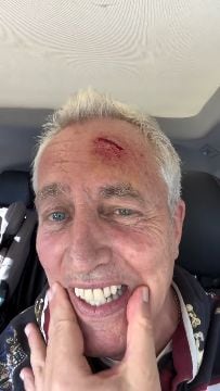 El conductor publicó imágenes del accidente en sus redes sociales con sangre en el rostro