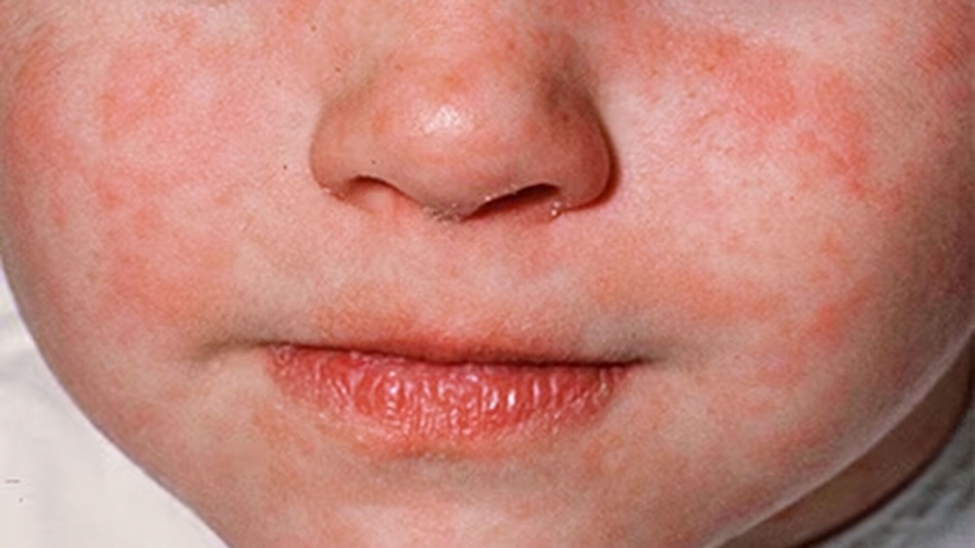 Unicef alertó que el sarampión es 12 veces más contagioso que la gripe y seis veces más que el ébola, una característica que exige coberturas por encima del 95 por ciento (Unicef)