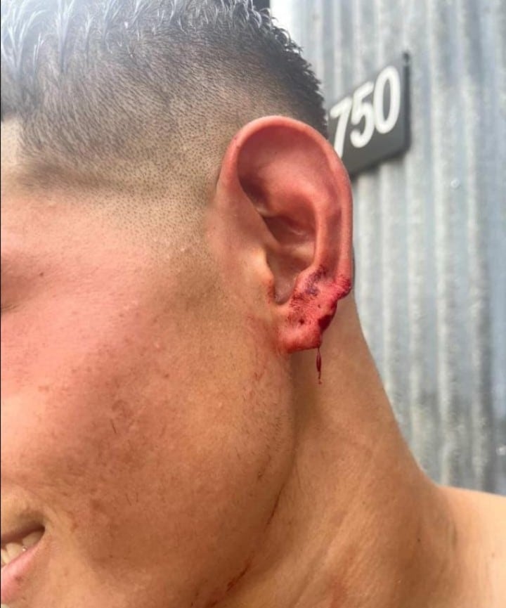 El estado en el que quedó la oreja de la persona que se peleó con Chipi Gandín (@radiogolsantafe)