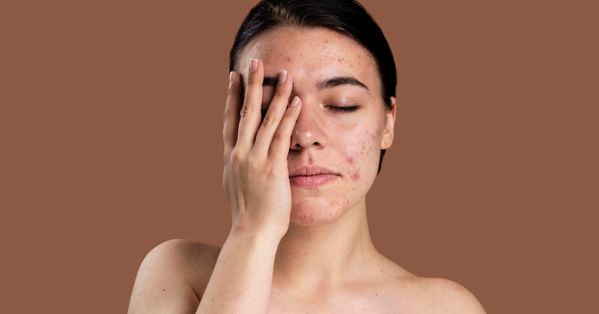 ¿Cómo el estrés afecta la salud de tu piel? La conexión entre mente y cuerpo