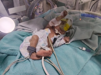 Además de la retinopatía del prematuro, Emmanuel enfrentó neumonía, enterocolitis y una infección asociada a un catéter, complicaciones que requirieron múltiples tratamientos y mantuvieron en riesgo su vida durante varias semanas - crédito suministrada a Infobae Colombia