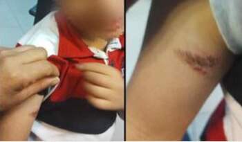 Quemadura niño kinder cuautitlán