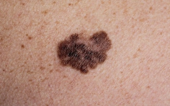 Melanoma (Shutterstock)