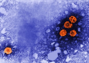 Imagen de microscopía electrónica de transmisión coloreada digitalmente revela la presencia de viriones de la hepatitis B (de color naranja). (Foto: CDC/DR. ERSKINE PALMER)
