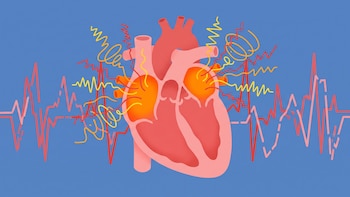 Qué es la fibrilación auricular: la condición cardíaca que en muchas ocasiones puede pasar desapercibida