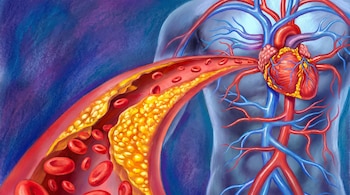 Sistema circulatorio humano con corazón, venas y arterias, una de ellas con glóbulos rojos y placas amarillas de colesterol que la obstruyen.