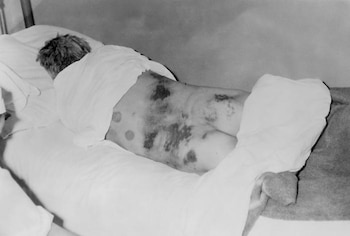 Paciente afectado por la fiebre Crimea-Congo en 1969 (Wikimedia Commons)