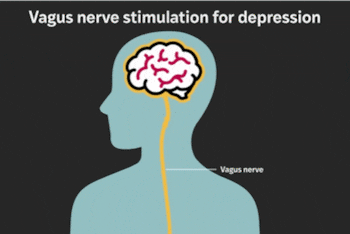 Un implante en el nervio vago puede disminuir hasta un 70% de los casos de depresión severa (Sara Moser/WashU Medicine)