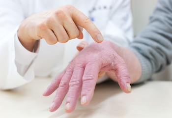 ARCHIVO - Los eccemas cutáneos